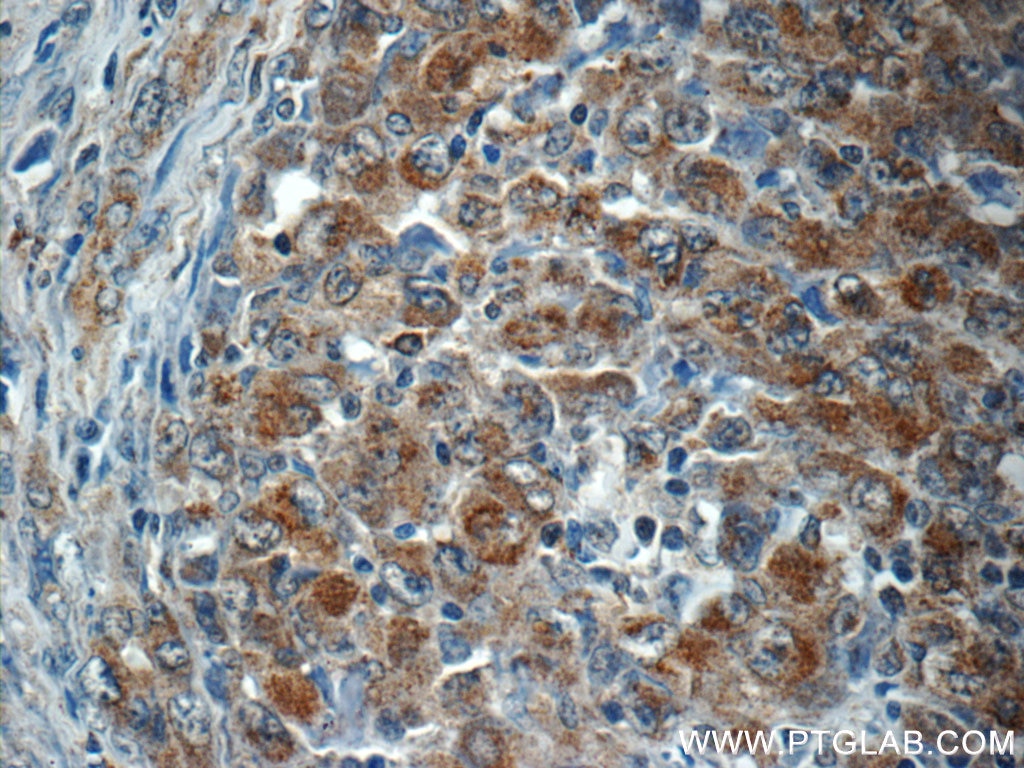 Immunohistochemistry (IHC) staining of human lymphoma tissue using ALK Polyclonal antibody (24184-1-AP)