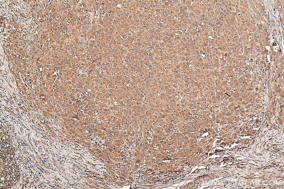 Immunohistochemistry (IHC) staining of human lymphoma tissue using ALK Monoclonal antibody (60321-1-Ig)