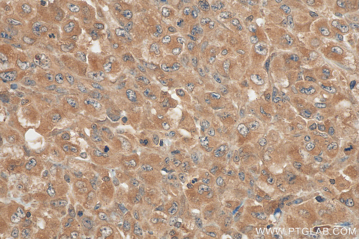 Immunohistochemistry (IHC) staining of human lymphoma tissue using ALK Monoclonal antibody (60321-1-Ig)