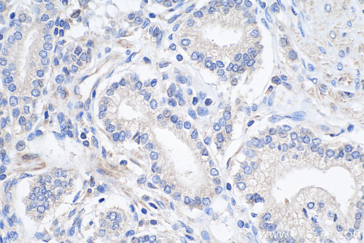 Immunohistochemistry (IHC) staining of human prostate cancer tissue using ALKBH3 Polyclonal antibody (12292-1-AP)
