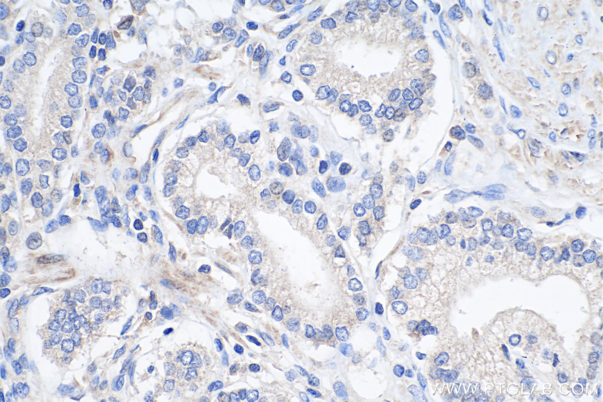 Immunohistochemistry (IHC) staining of human prostate cancer tissue using ALKBH3 Polyclonal antibody (12292-1-AP)