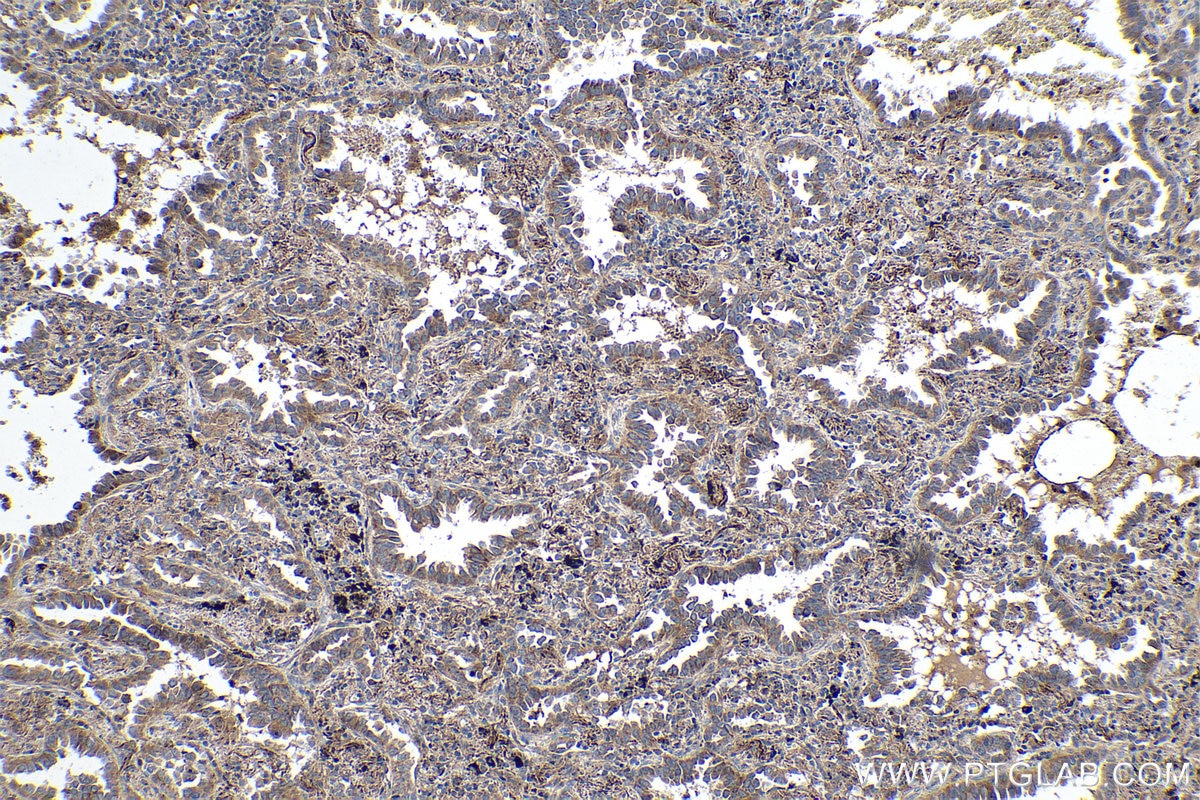 Immunohistochemistry (IHC) staining of human lung cancer tissue using ALKBH3 Polyclonal antibody (12292-1-AP)