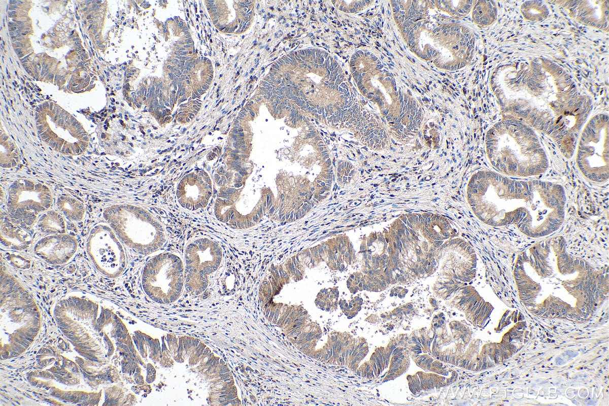 Immunohistochemistry (IHC) staining of human pancreas cancer tissue using ALKBH3 Polyclonal antibody (12292-1-AP)
