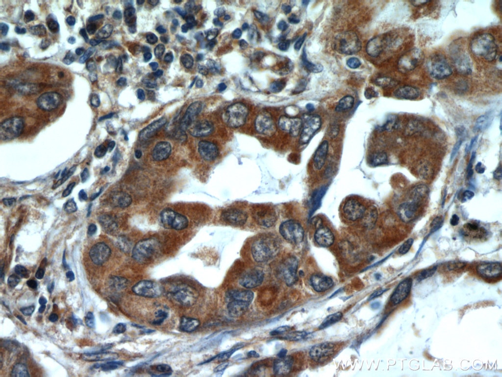 Immunohistochemistry (IHC) staining of human lung cancer tissue using ALKBH3 Polyclonal antibody (12292-1-AP)