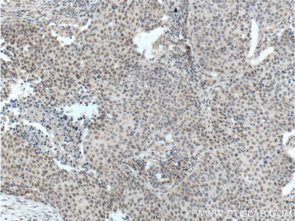 Immunohistochemistry (IHC) staining of human lung cancer tissue using ALKBH5 Polyclonal antibody (16837-1-AP)