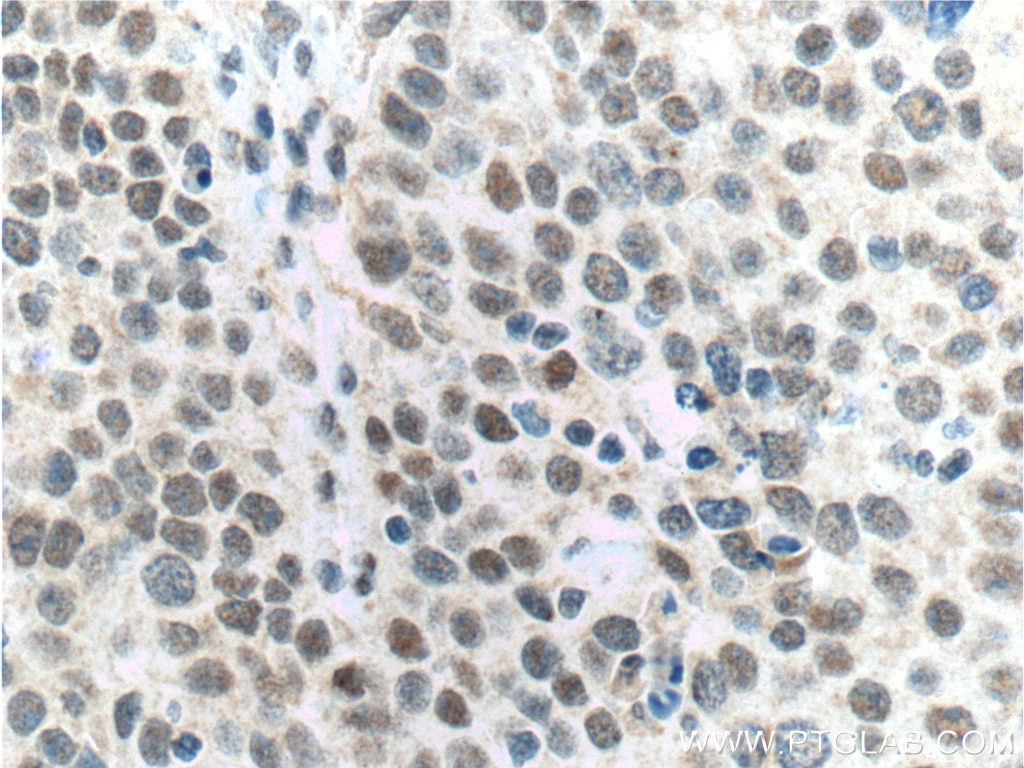 Immunohistochemistry (IHC) staining of human lung cancer tissue using ALKBH5 Polyclonal antibody (16837-1-AP)