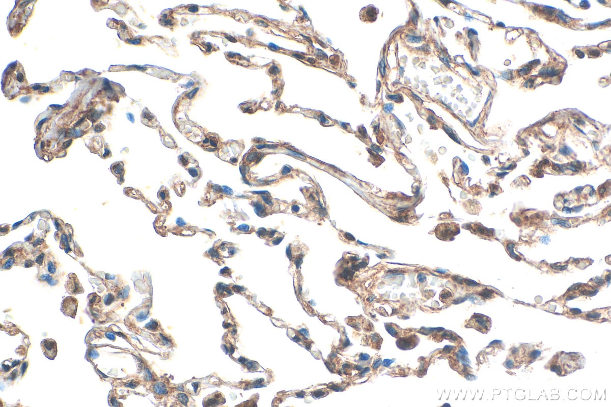 Immunohistochemical analysis of paraffin-embedded human lung tissue slide using 27231-1-AP (ALMS1 antibody) at dilution of 1:200 (under 40x lens). Heat mediated antigen retrieval with Tris-EDTA buffer (pH 9.0). Immunohistochemistry (IHC) staining of human lung tissue using ALMS1 Polyclonal antibody (27231-1-AP)