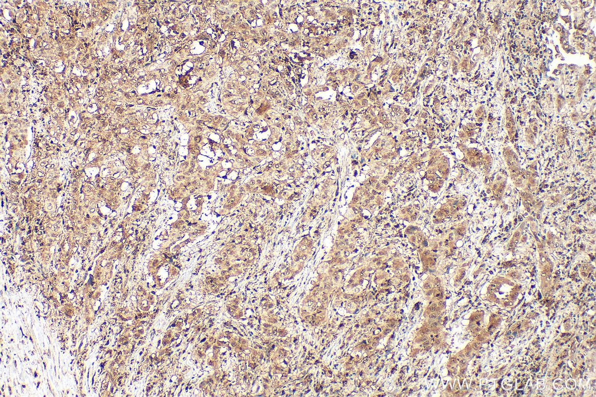 Immunohistochemistry (IHC) staining of human lung cancer tissue using 5 Lipoxygenase Polyclonal antibody (10021-1-Ig)