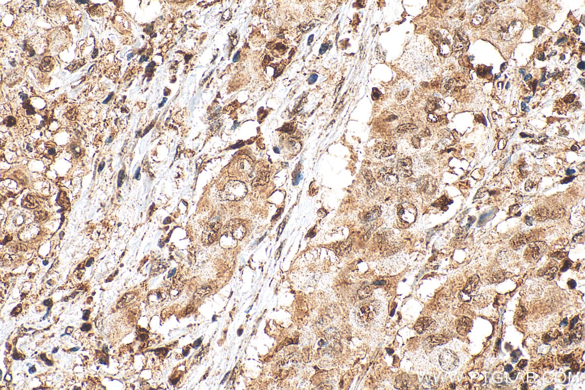 Immunohistochemistry (IHC) staining of human lung cancer tissue using 5 Lipoxygenase Polyclonal antibody (10021-1-Ig)
