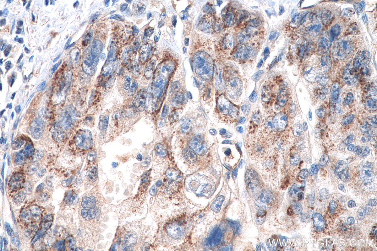 Immunohistochemistry (IHC) staining of human liver cancer tissue using ALPL Polyclonal antibody (11187-1-AP)