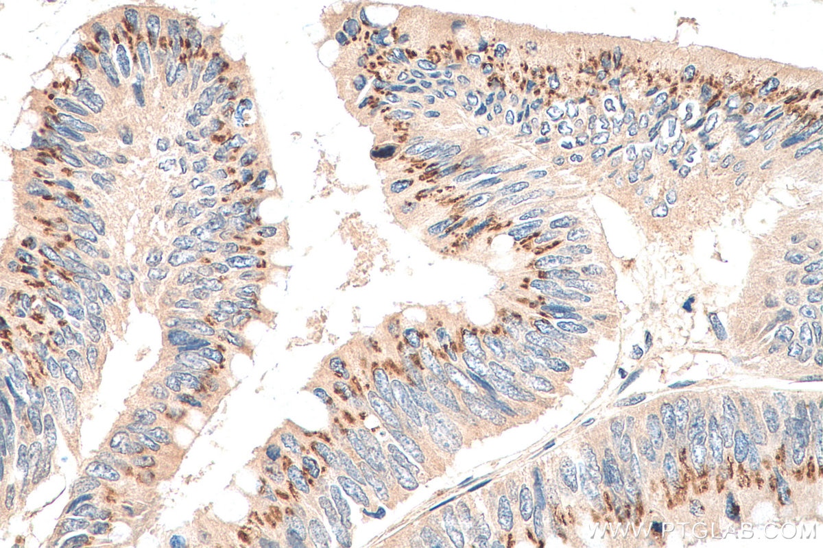 Immunohistochemistry (IHC) staining of human colon cancer tissue using ALPL Polyclonal antibody (11187-1-AP)