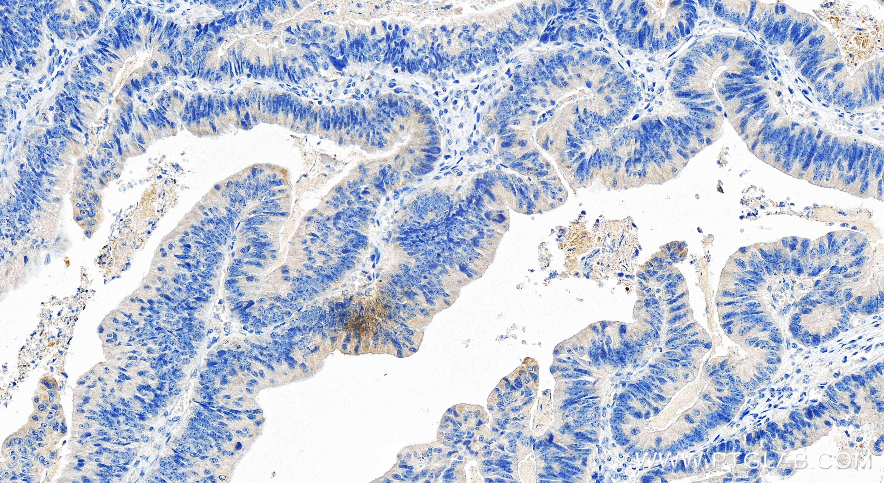 Immunohistochemistry (IHC) staining of human colon cancer tissue using ALR Recombinant antibody (84972-4-RR)