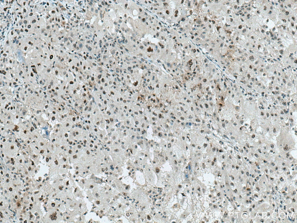 Immunohistochemistry (IHC) staining of human liver cancer tissue using ALY Polyclonal antibody (16690-1-AP)