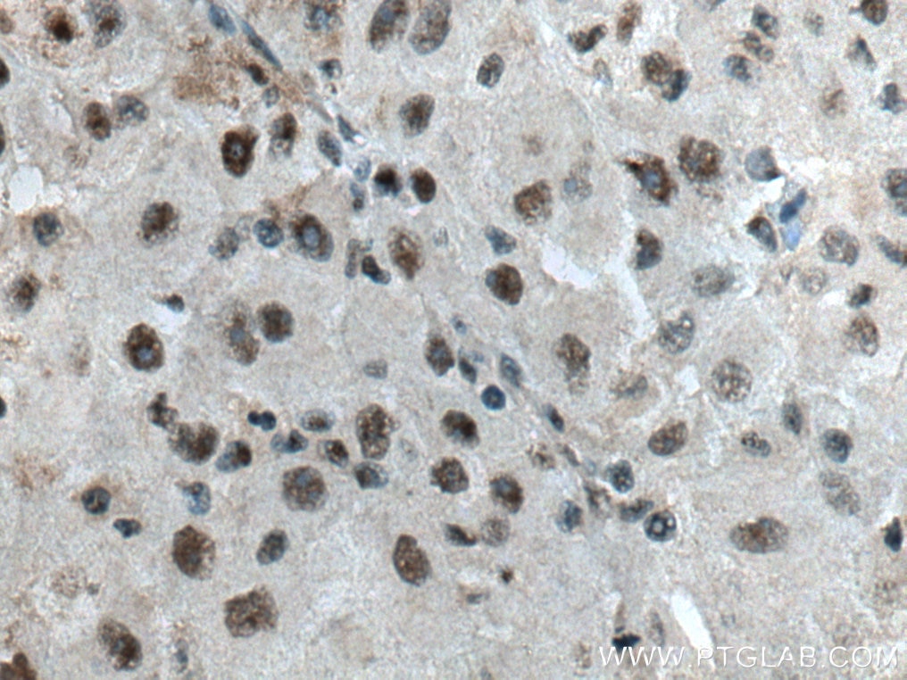 Immunohistochemistry (IHC) staining of human liver cancer tissue using ALY Polyclonal antibody (16690-1-AP)