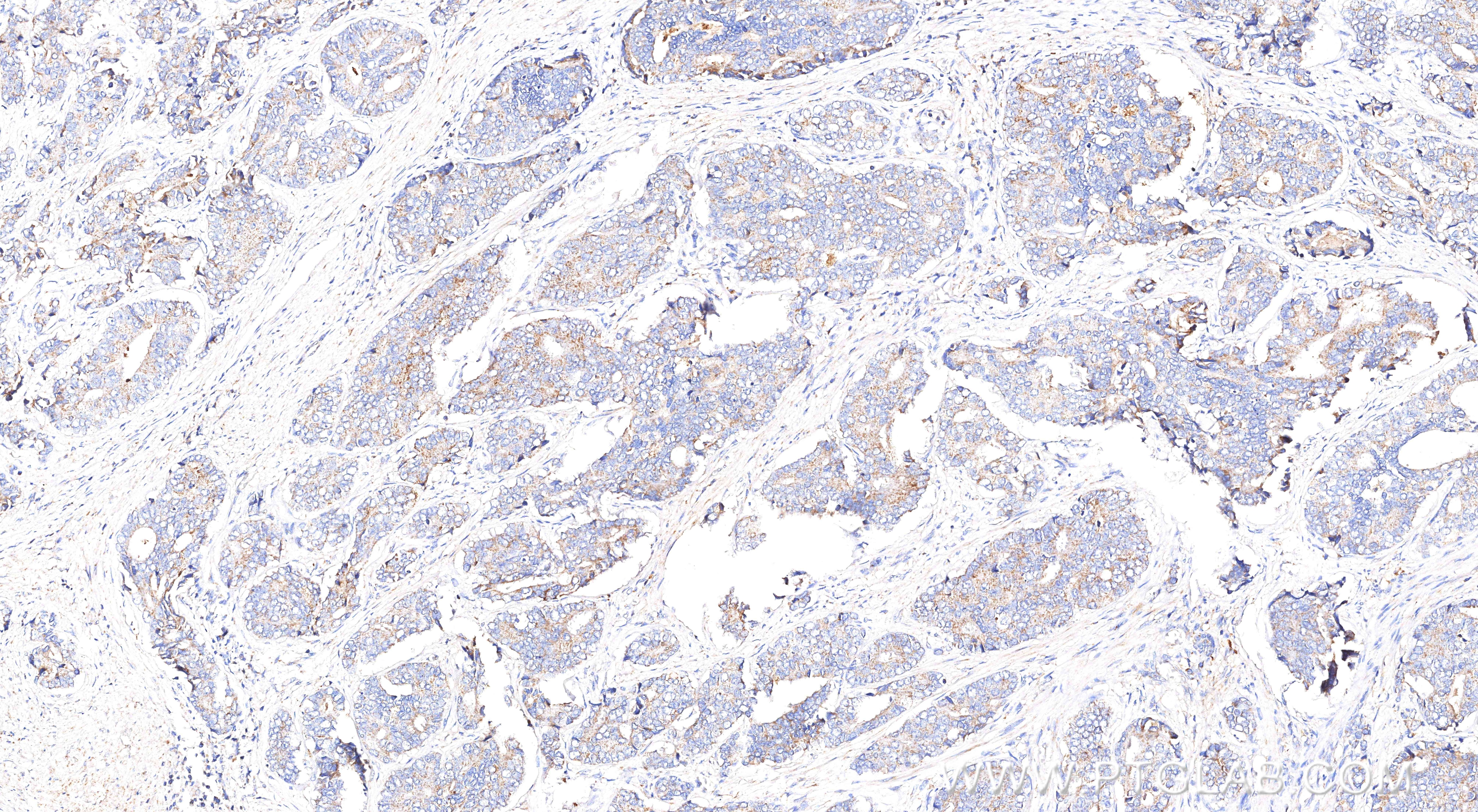 IHC staining of human prostate cancer using 84891-9-RR (same clone as 84891-9-PBS) Immunohistochemistry (IHC) staining of human prostate cancer tissue using AMACR/p504S Recombinant monoclonal antibody (84891-9-RR)