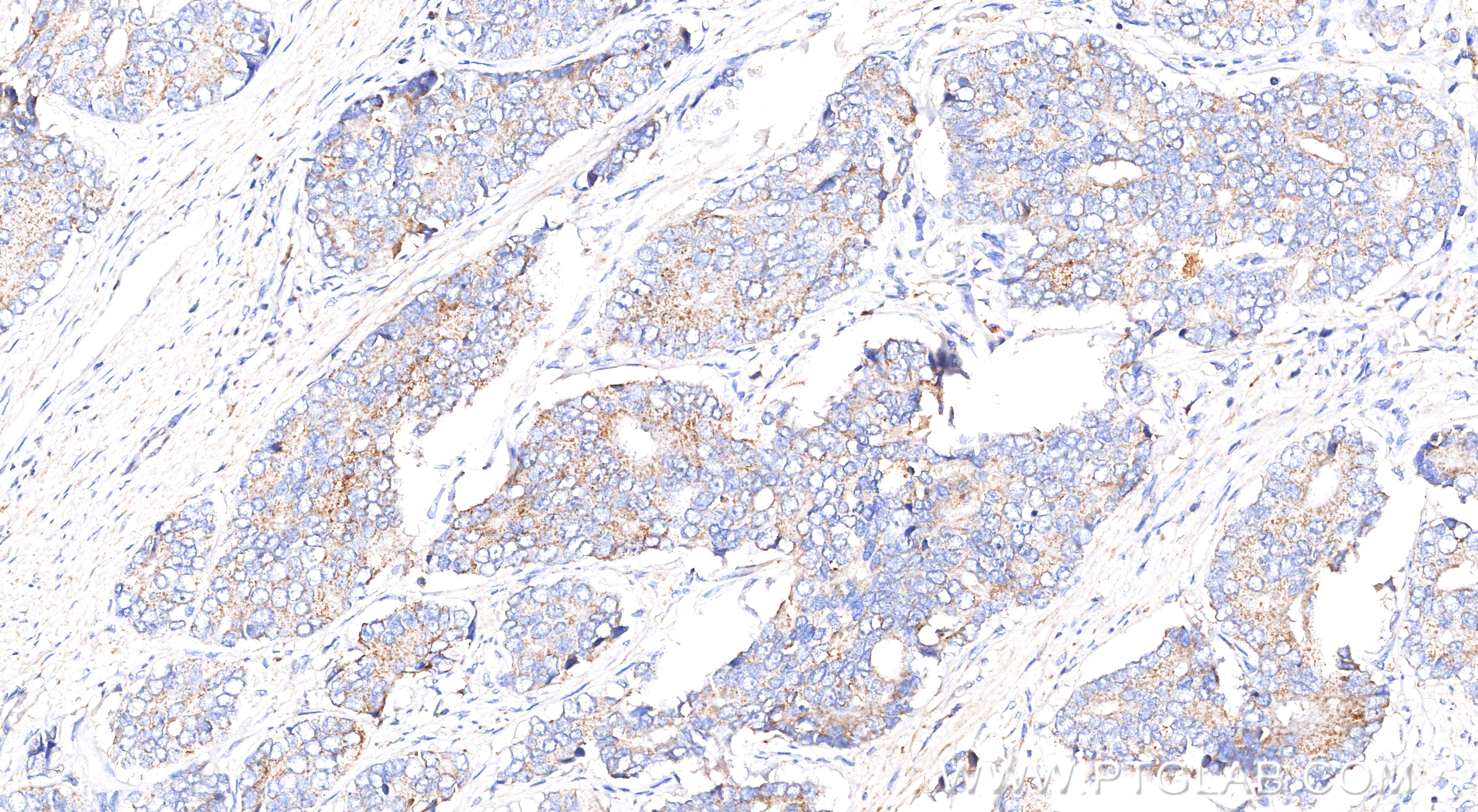 IHC staining of human prostate cancer using 84891-9-RR (same clone as 84891-9-PBS) Immunohistochemistry (IHC) staining of human prostate cancer tissue using AMACR/p504S Recombinant monoclonal antibody (84891-9-RR)