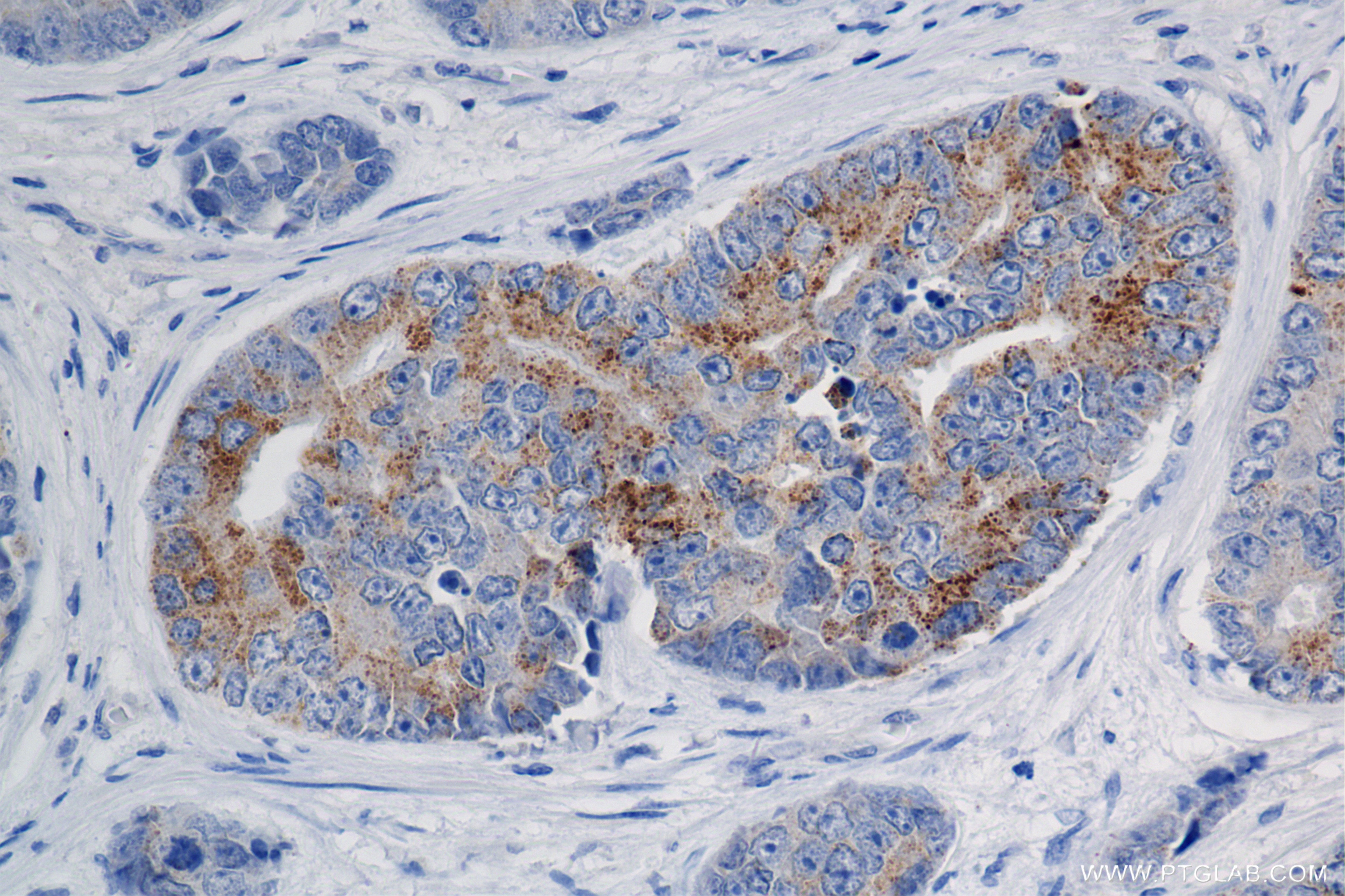 Immunohistochemistry (IHC) staining of human prostate cancer tissue using AMACR/p504S Recombinant antibody (84891-2-RR)