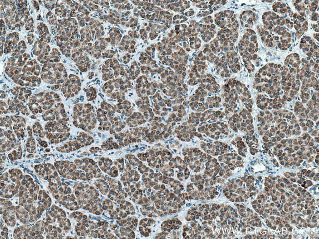 Immunohistochemistry (IHC) staining of human liver cancer tissue using AMBRA1 Polyclonal antibody (13762-1-AP)