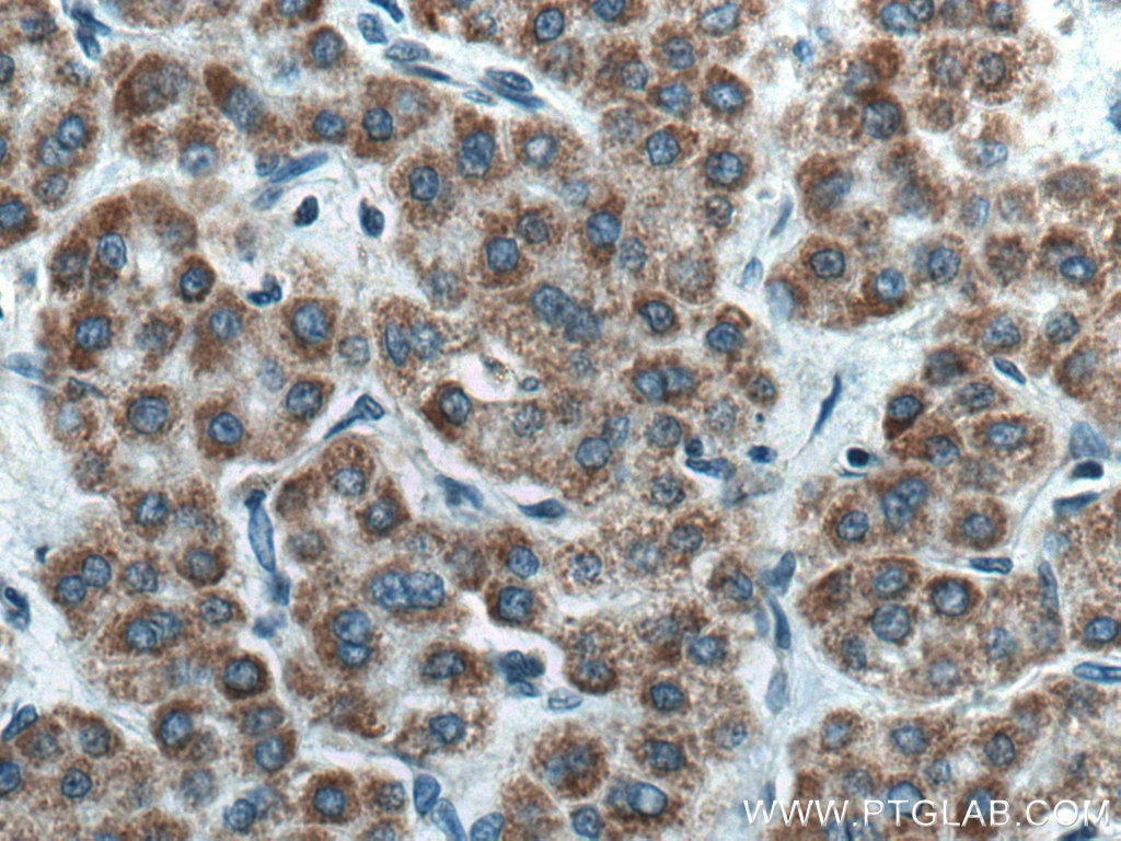 Immunohistochemistry (IHC) staining of human liver cancer tissue using AMBRA1 Polyclonal antibody (13762-1-AP)