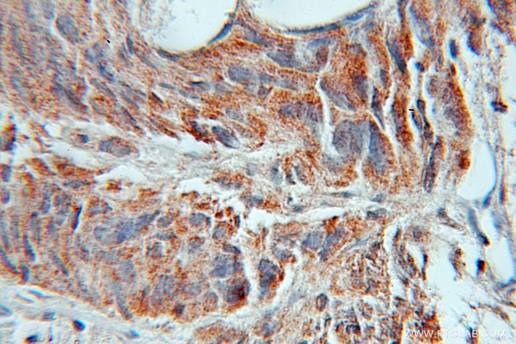 Immunohistochemistry (IHC) staining of human prostate cancer tissue using AMD1 Polyclonal antibody (11052-1-AP)