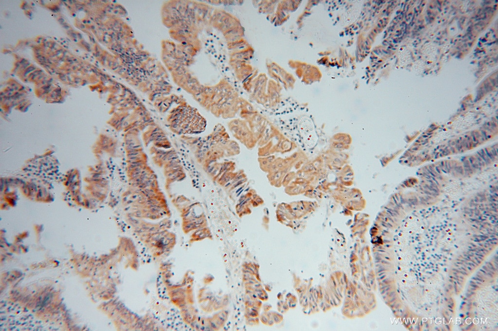 Immunohistochemistry (IHC) staining of human colon cancer tissue using AMD1 Polyclonal antibody (11052-1-AP)