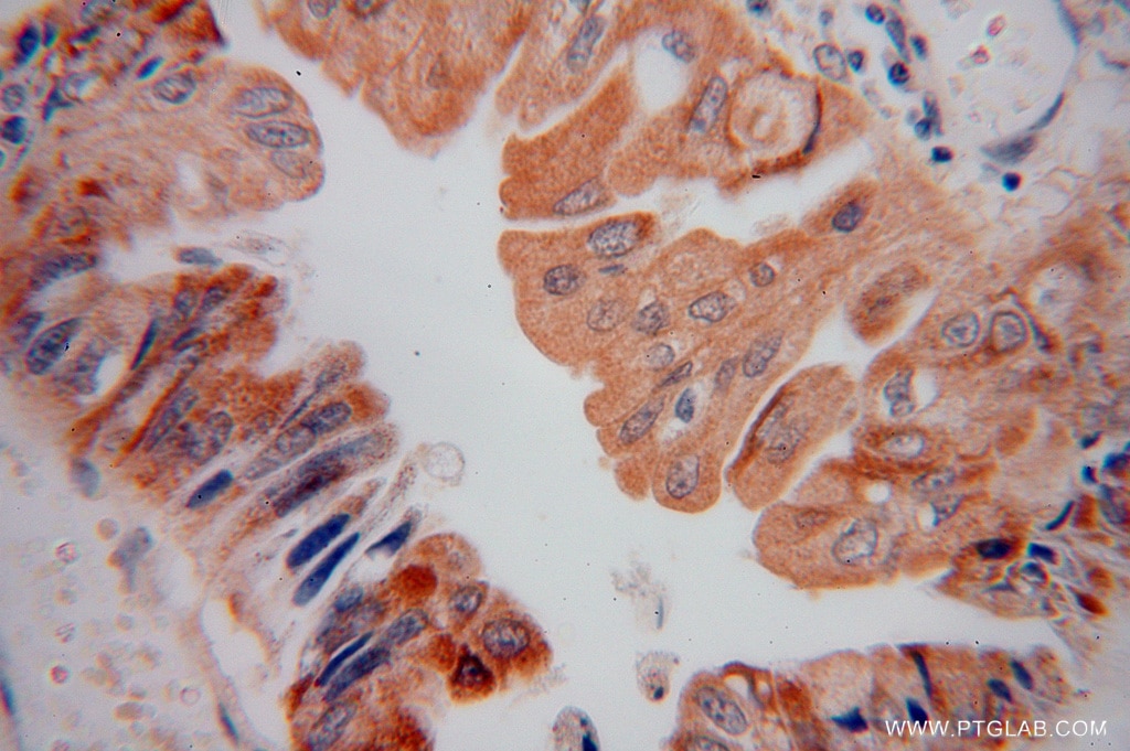 Immunohistochemistry (IHC) staining of human colon cancer tissue using AMD1 Polyclonal antibody (11052-1-AP)