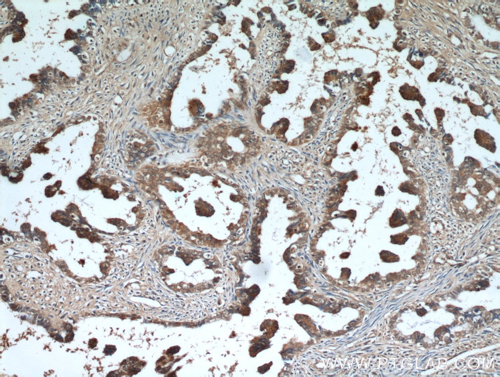 Immunohistochemistry (IHC) staining of human ovary tumor tissue using AMH Polyclonal antibody (14461-1-AP)