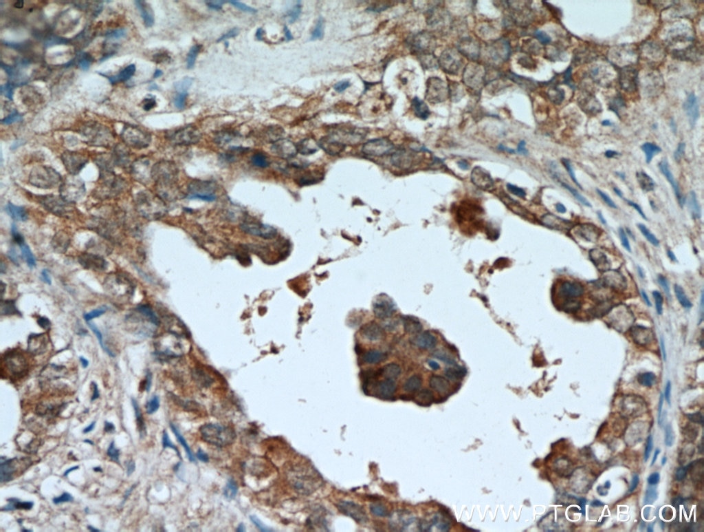 Immunohistochemistry (IHC) staining of human ovary tumor tissue using AMH Polyclonal antibody (14461-1-AP)