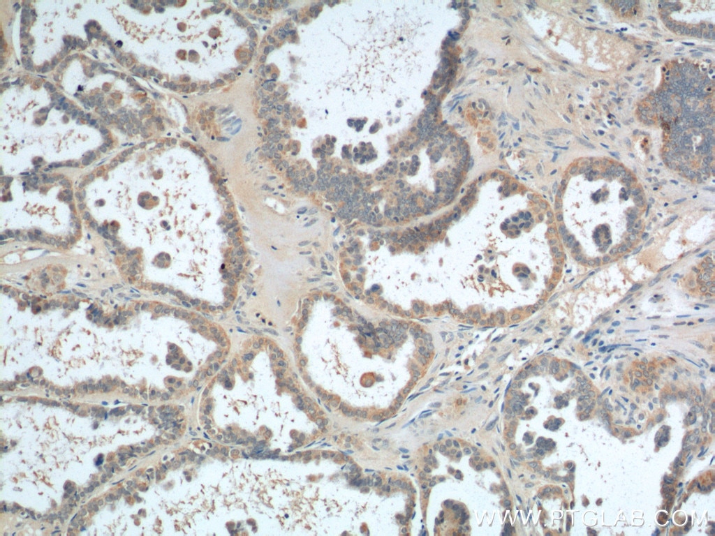 IHC staining of human ovary tumor using 25888-1-AP