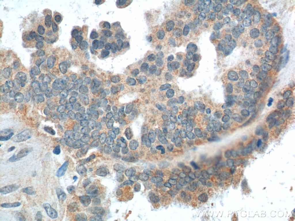 Immunohistochemistry (IHC) staining of human ovary tumor tissue using AMHR2 Polyclonal antibody (25888-1-AP)