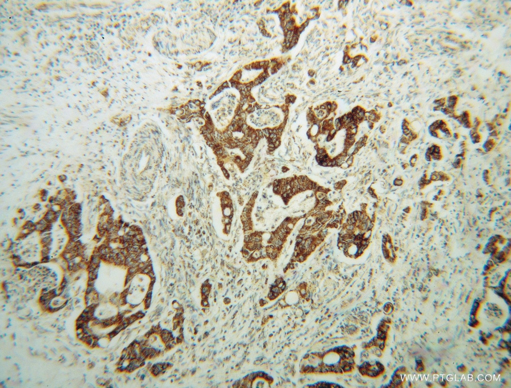 Immunohistochemistry (IHC) staining of human colon cancer tissue using AMN1 Polyclonal antibody (14694-1-AP)