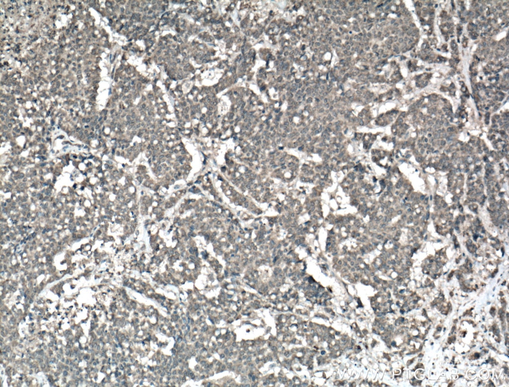 IHC staining of human colon cancer using 24550-1-AP