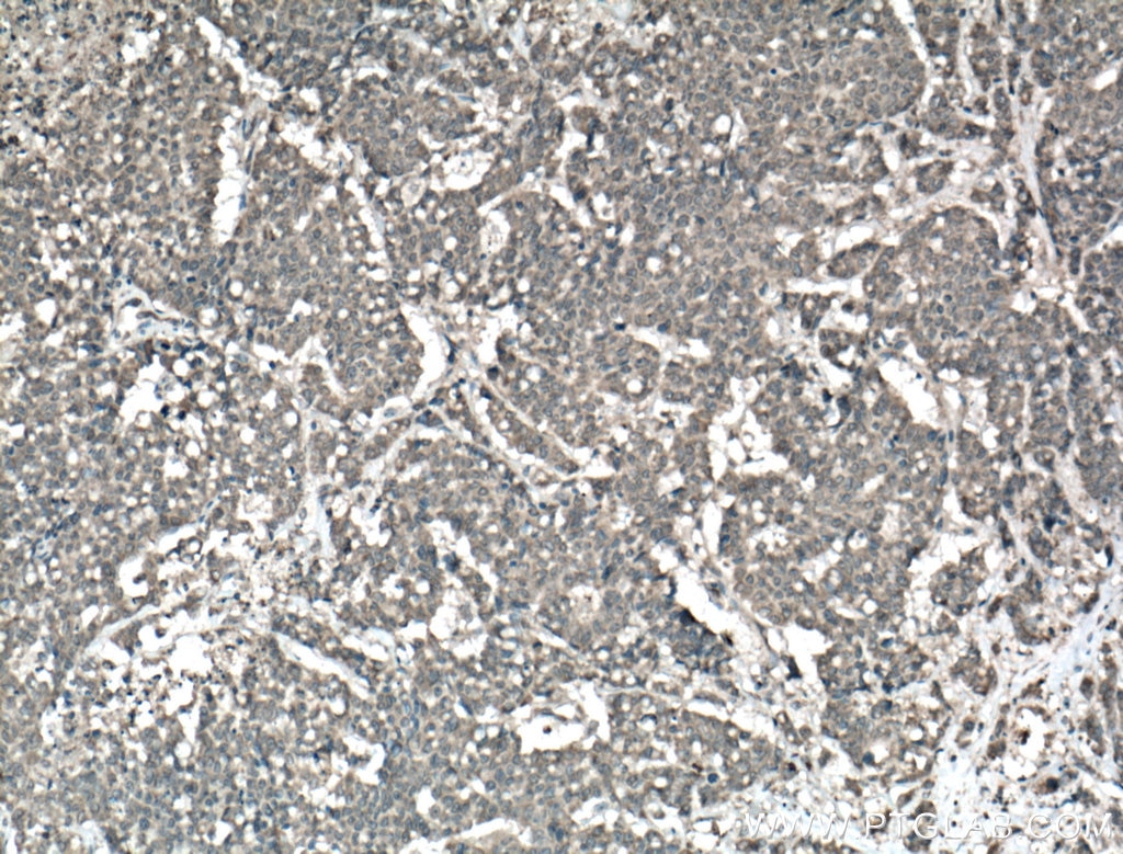 Immunohistochemistry (IHC) staining of human colon cancer tissue using AMOT Polyclonal antibody (24550-1-AP)