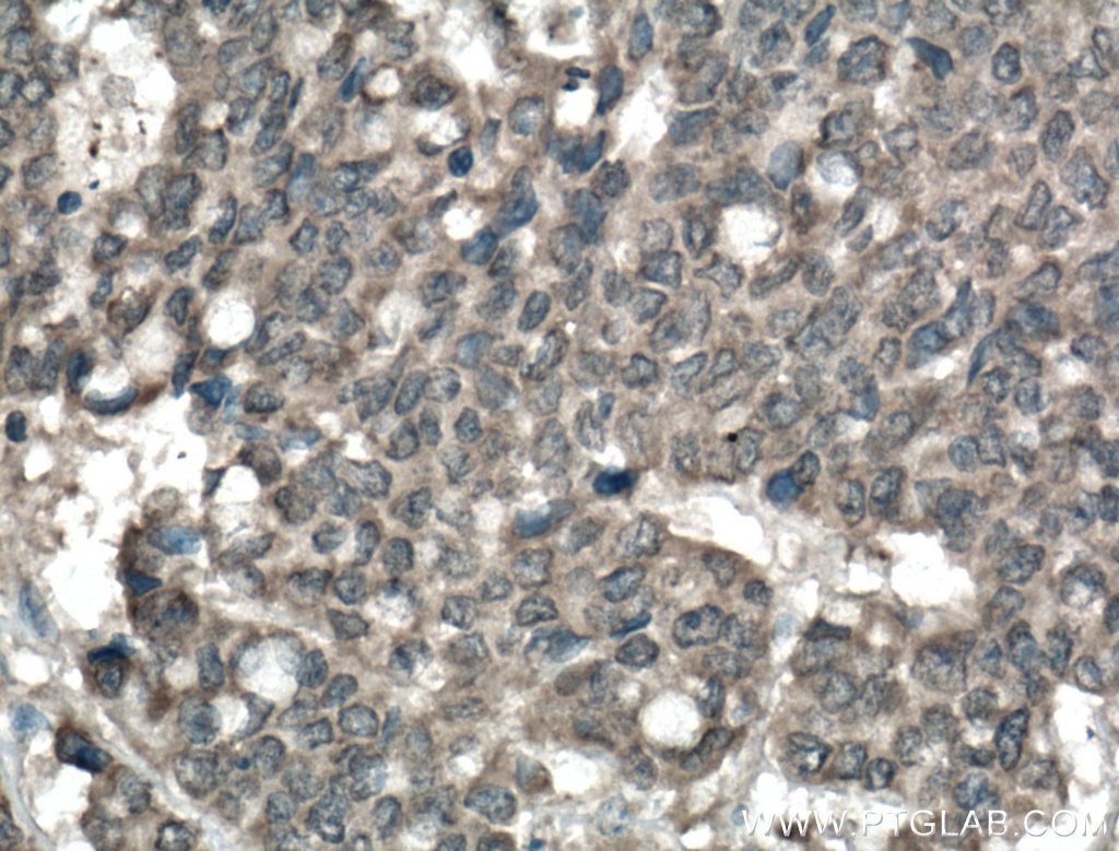 Immunohistochemistry (IHC) staining of human colon cancer tissue using AMOT Polyclonal antibody (24550-1-AP)