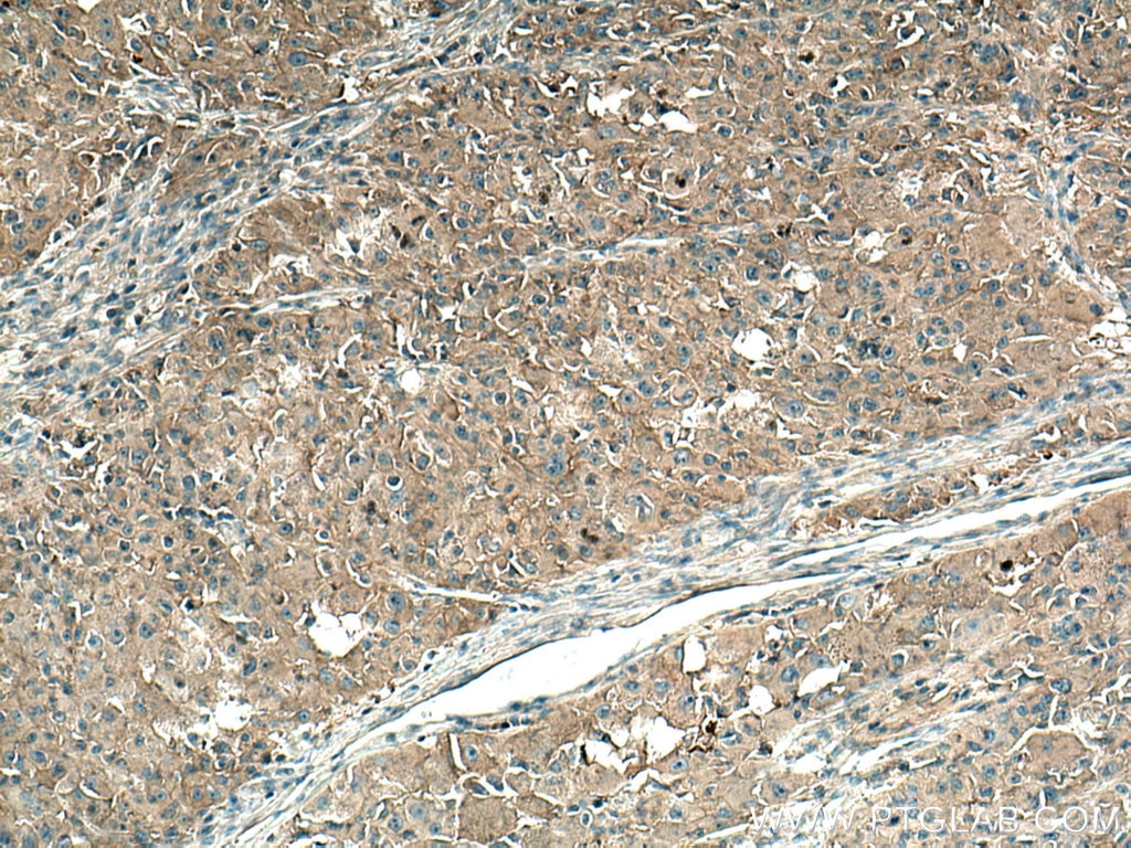 Immunohistochemistry (IHC) staining of human liver cancer tissue using AMPD2 Monoclonal antibody (67430-1-Ig)