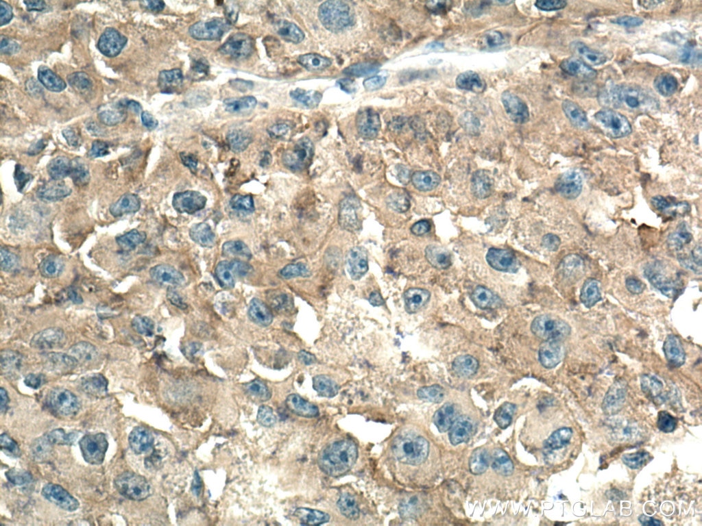 Immunohistochemistry (IHC) staining of human liver cancer tissue using AMPD2 Monoclonal antibody (67430-1-Ig)