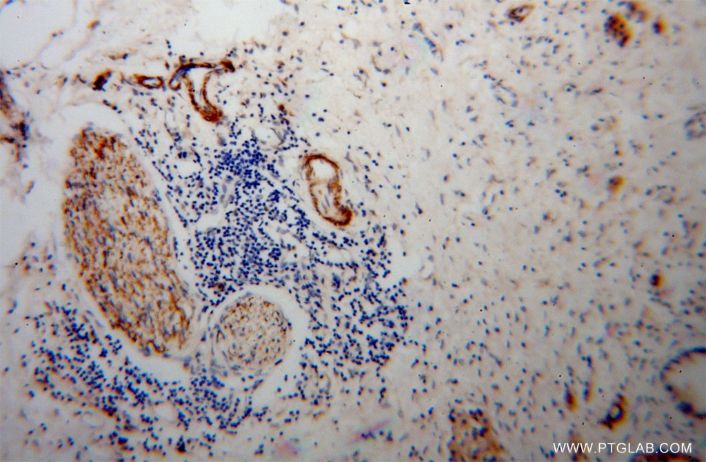 Immunohistochemistry (IHC) staining of human pancreas cancer tissue using Amphiphysin Polyclonal antibody (13379-1-AP)