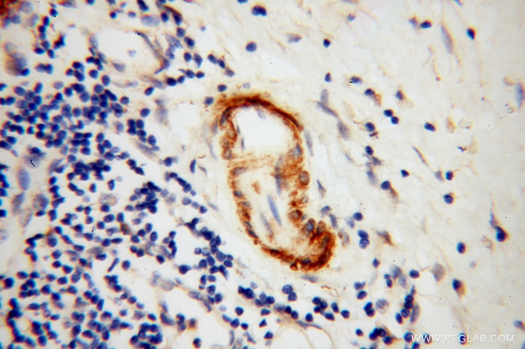 Immunohistochemistry (IHC) staining of human pancreas cancer tissue using Amphiphysin Polyclonal antibody (13379-1-AP)