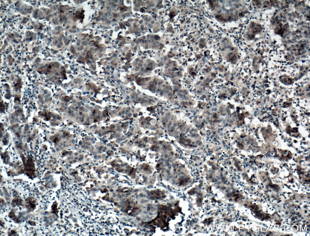 Immunohistochemistry (IHC) staining of human prostate cancer tissue using AMPK Alpha 1 Monoclonal antibody (66536-1-Ig)