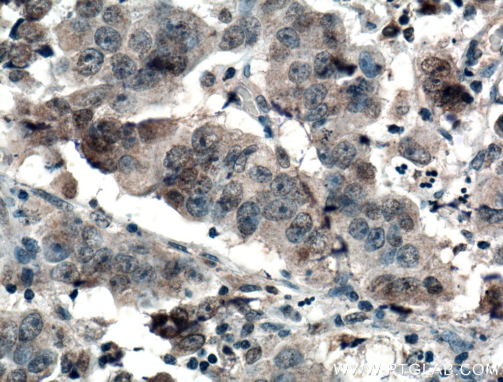 Immunohistochemistry (IHC) staining of human prostate cancer tissue using AMPK Alpha 1 Monoclonal antibody (66536-1-Ig)
