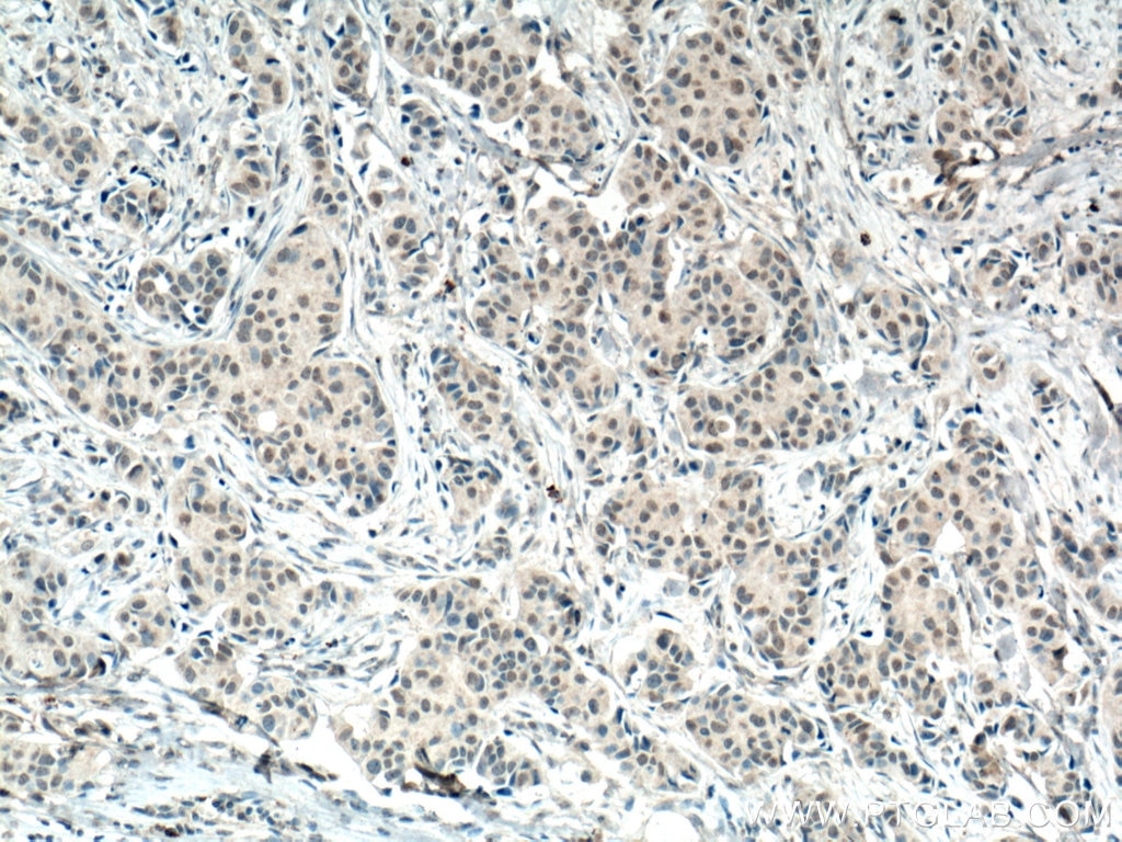 Immunohistochemistry (IHC) staining of human breast cancer tissue using AMPK Alpha 1 Monoclonal antibody (66536-1-Ig)
