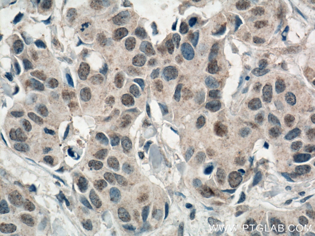 Immunohistochemistry (IHC) staining of human breast cancer tissue using AMPK Alpha 1 Monoclonal antibody (66536-1-Ig)
