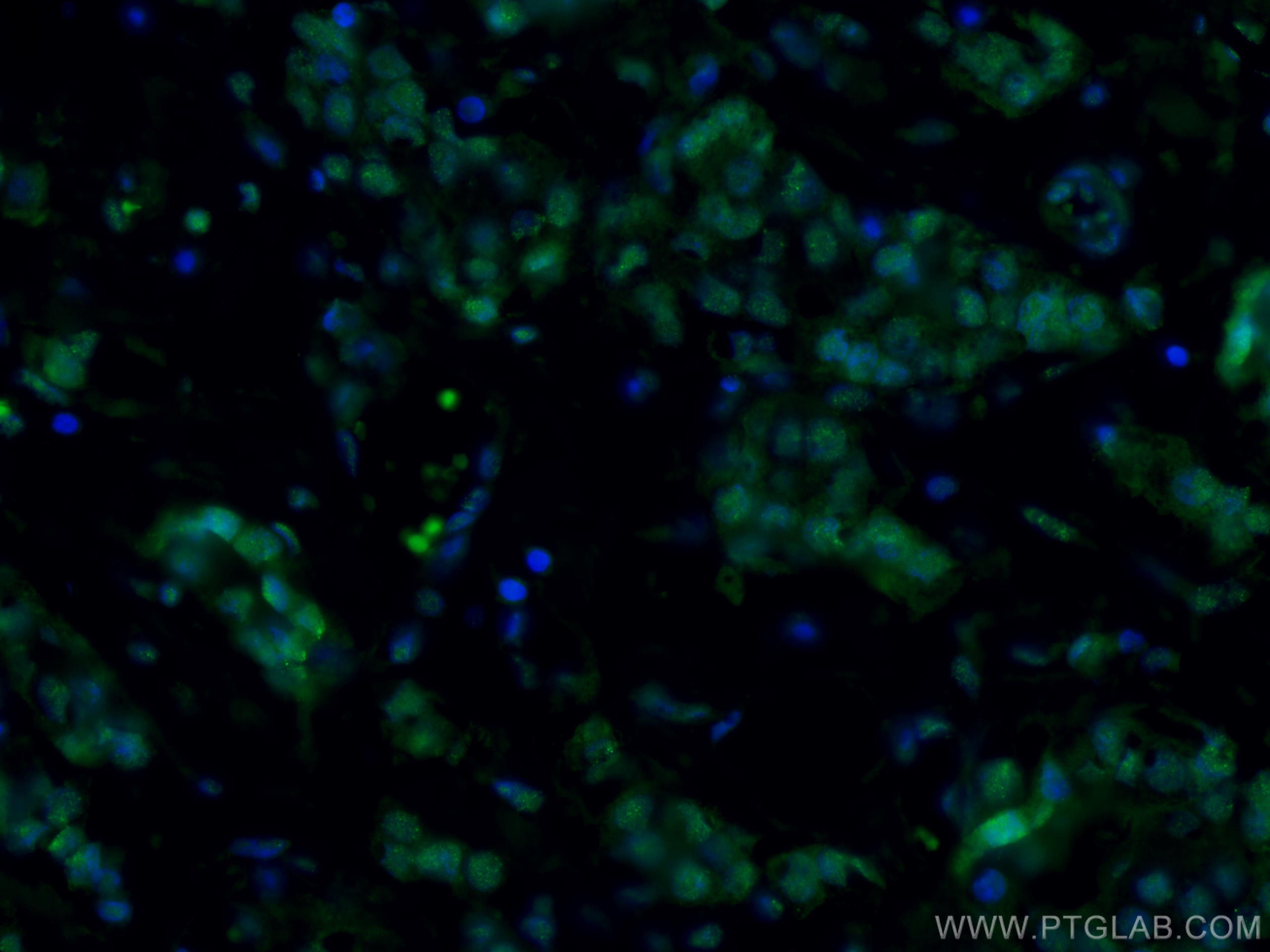 Immunofluorescence (IF) / fluorescent staining of human breast cancer tissue using CoraLite® Plus 488-conjugated AMPK Alpha Monoclona (CL488-66536)