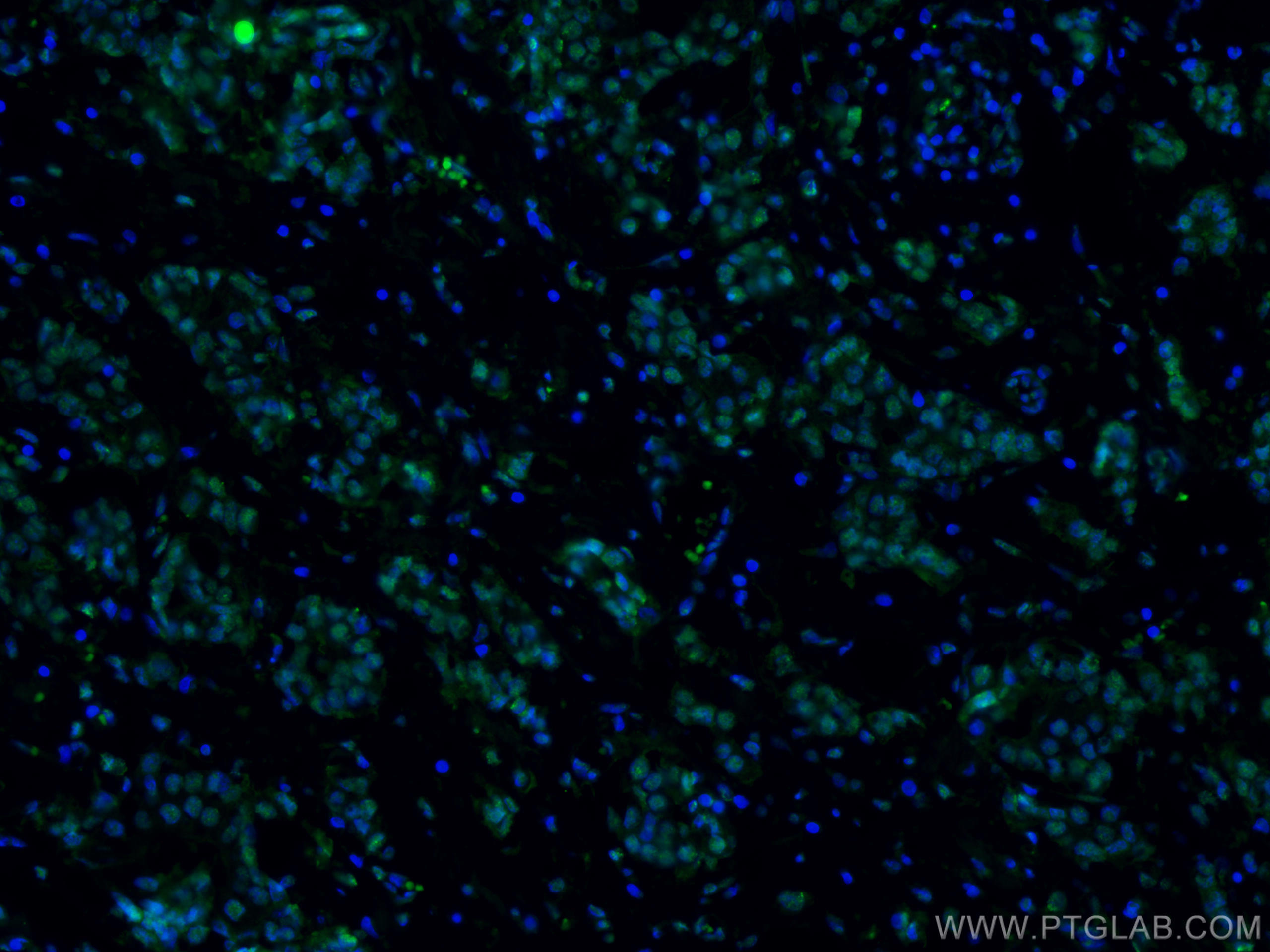 Immunofluorescence (IF) / fluorescent staining of human breast cancer tissue using CoraLite® Plus 488-conjugated AMPK Alpha Monoclona (CL488-66536)