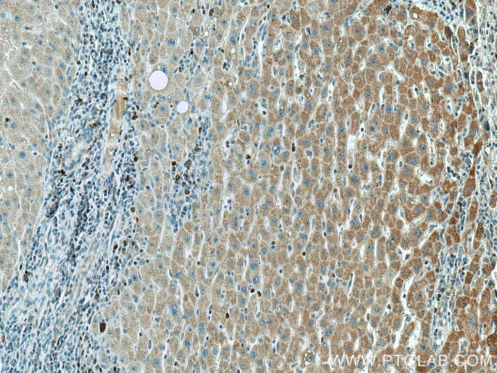 Immunohistochemistry (IHC) staining of human liver cancer tissue using AMT Monoclonal antibody (67532-1-Ig)