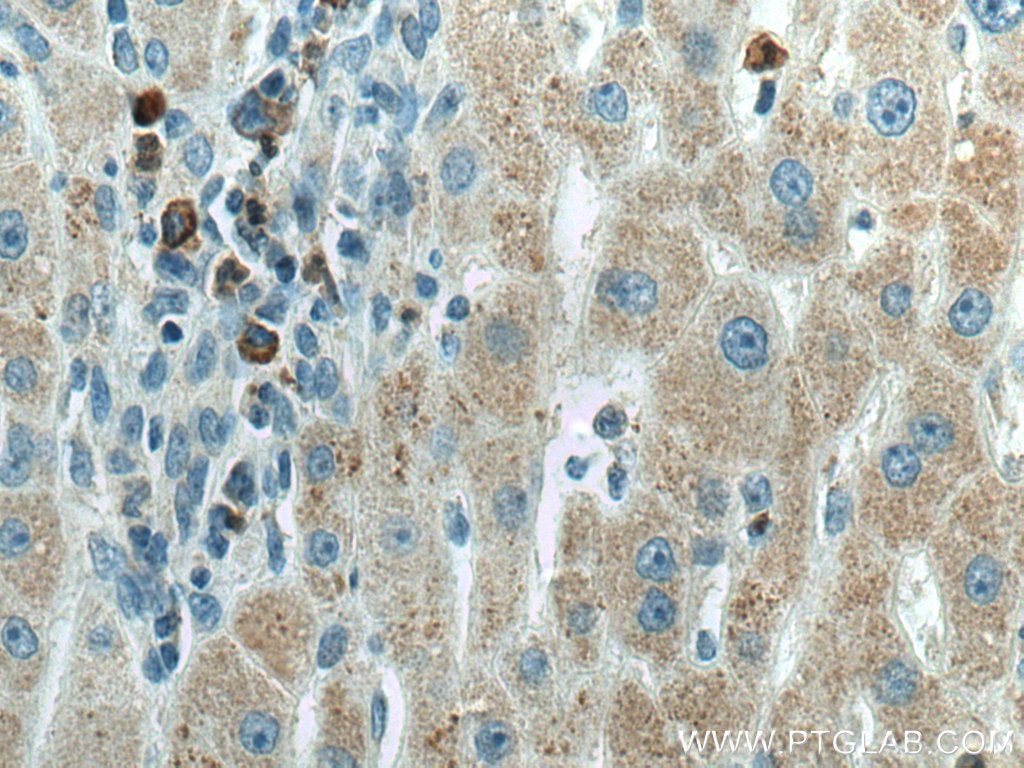 Immunohistochemistry (IHC) staining of human liver cancer tissue using AMT Monoclonal antibody (67532-1-Ig)