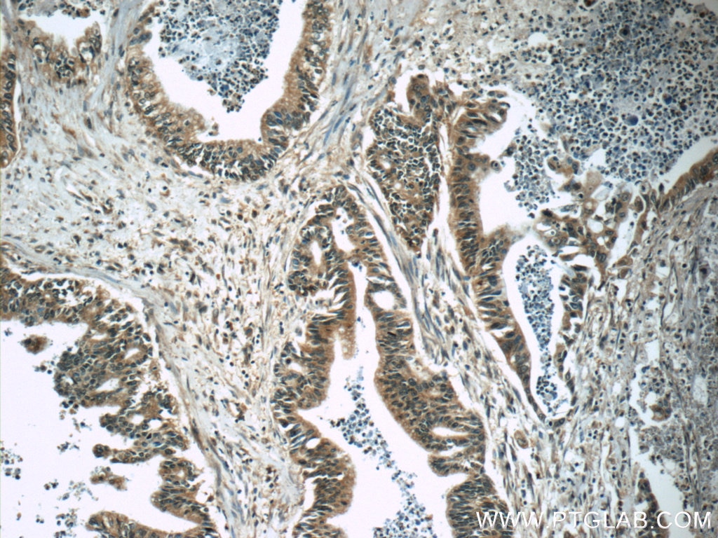 Immunohistochemistry (IHC) staining of human pancreas cancer tissue using Amylase Alpha Monoclonal antibody (66133-1-Ig)
