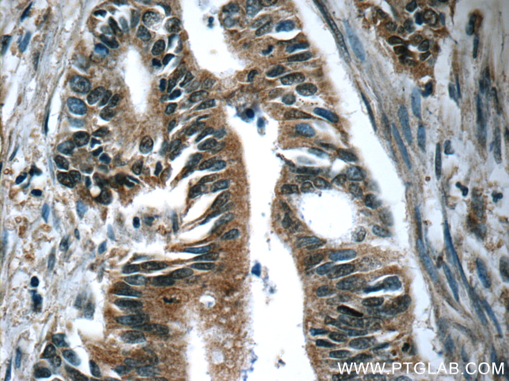 Immunohistochemistry (IHC) staining of human pancreas cancer tissue using Amylase Alpha Monoclonal antibody (66133-1-Ig)