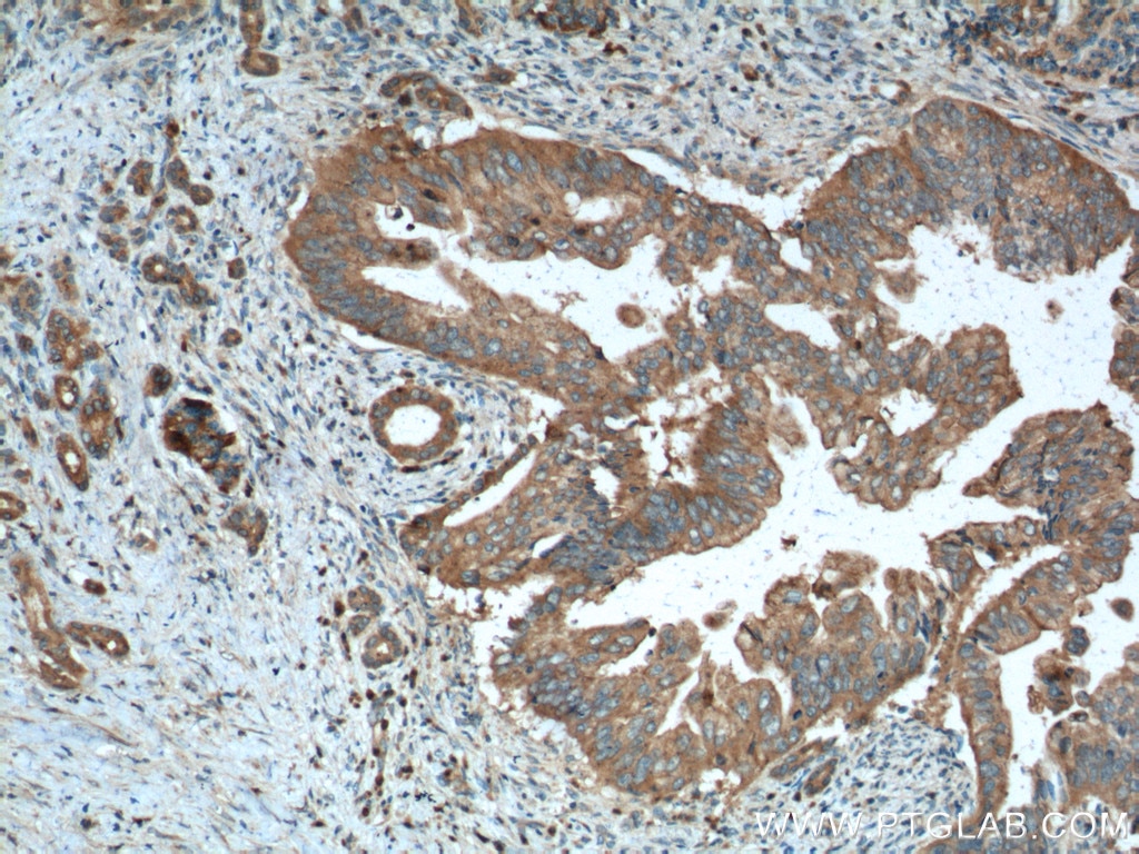 Immunohistochemistry (IHC) staining of human pancreas cancer tissue using Amylase Alpha Polyclonal antibody (12540-1-AP)