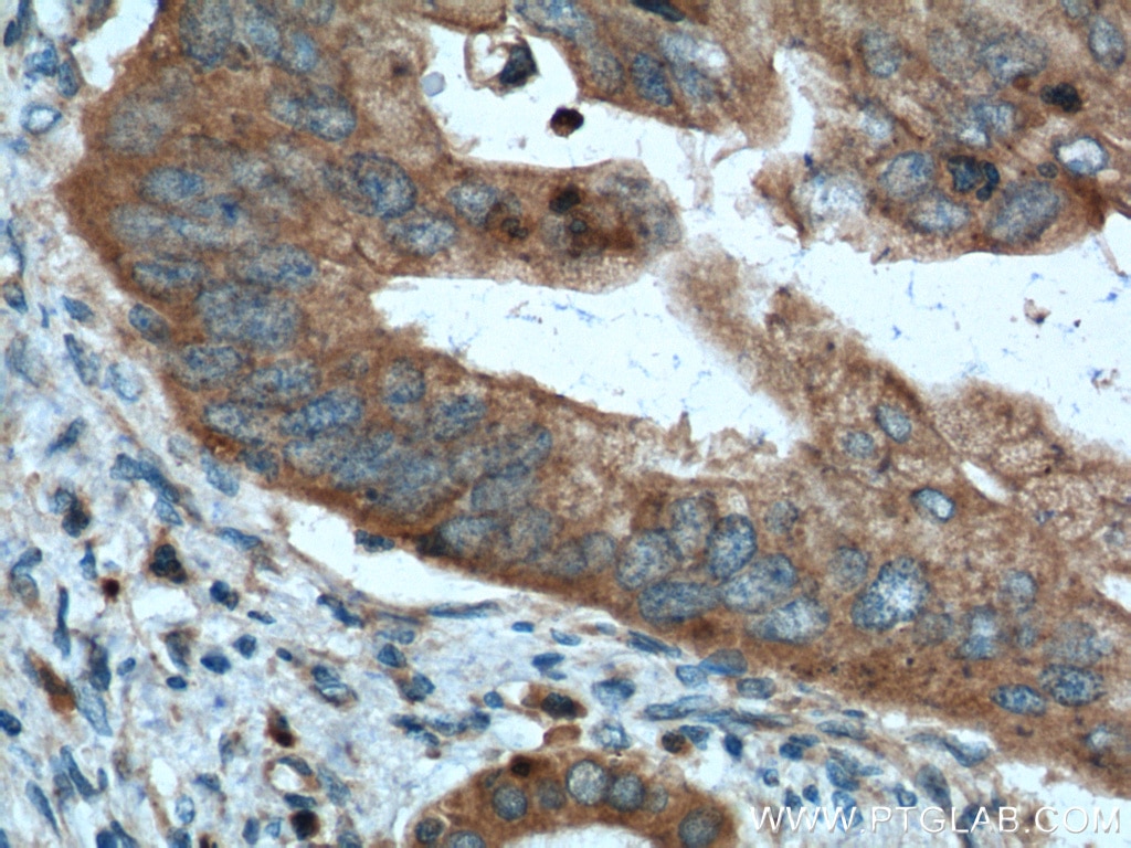 Immunohistochemistry (IHC) staining of human pancreas cancer tissue using Amylase Alpha Polyclonal antibody (12540-1-AP)